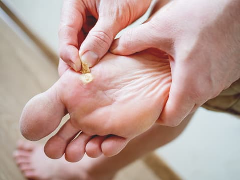 How are warts identified & treated?