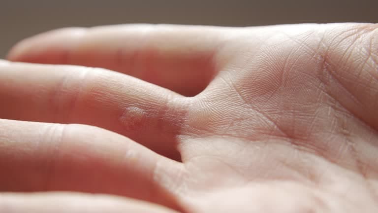 Why You Shouldn’t Leave a Wart Untreated?