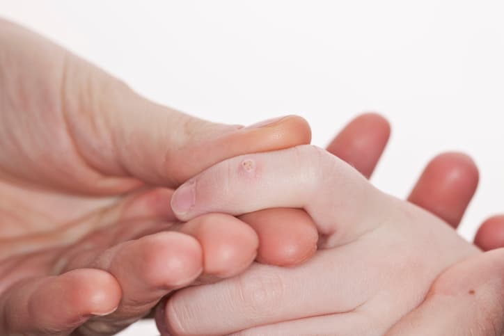 How can I prevent warts?