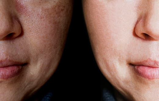 Melasma diagnosis tests