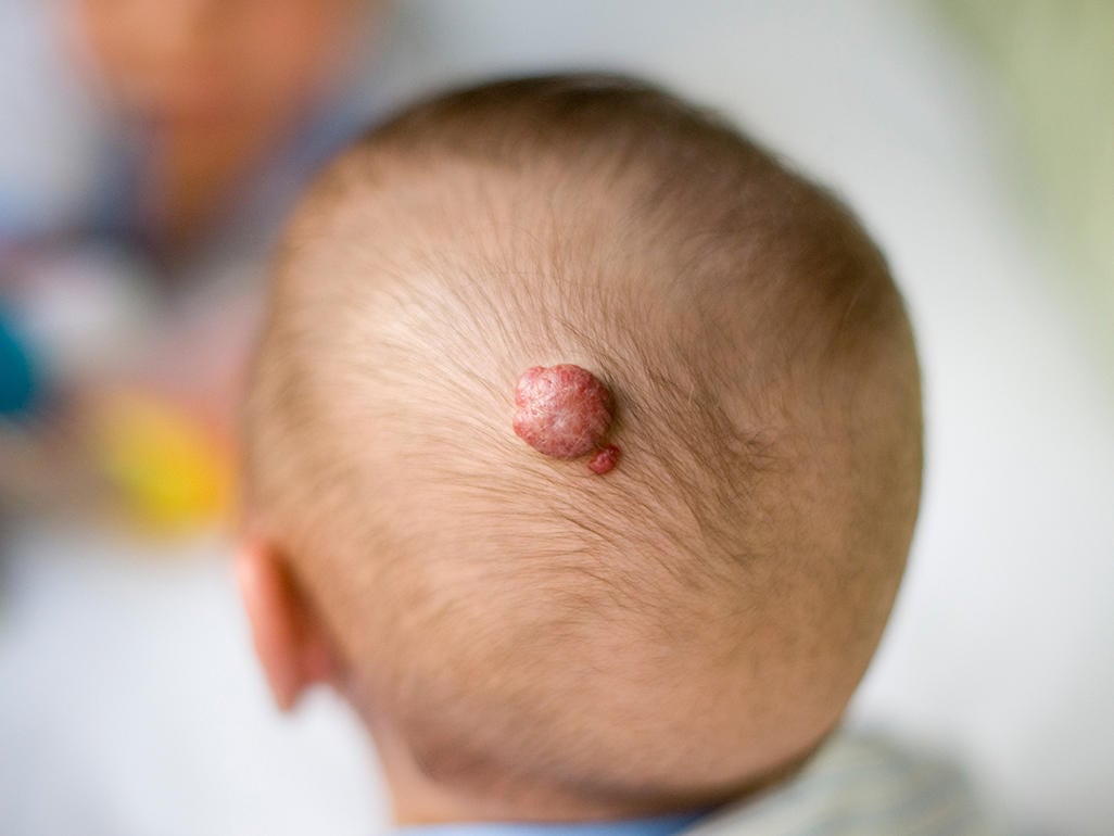 What are Strawberry Hemangiomas?
