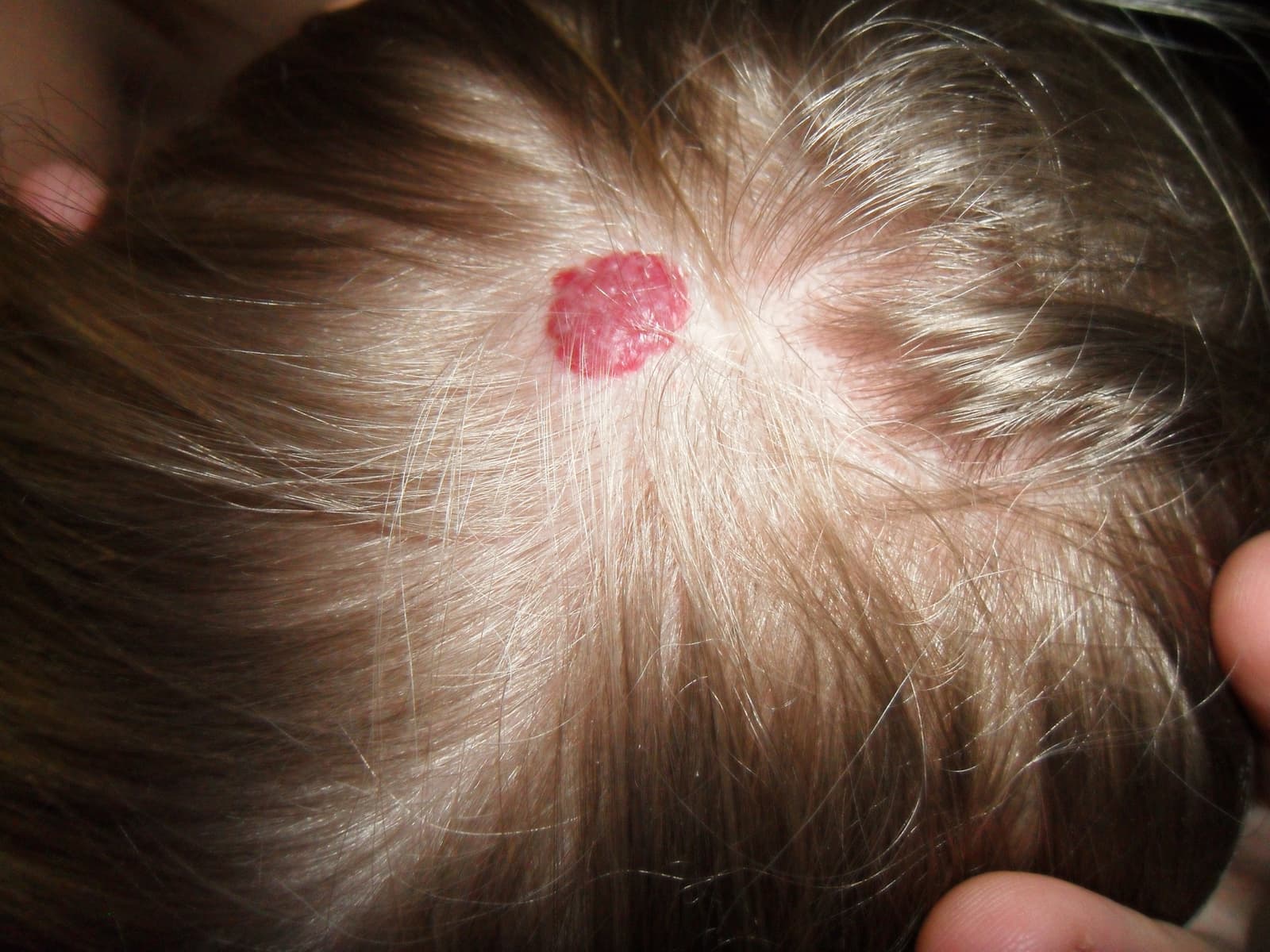 Strawberry Hemangiomas in adults