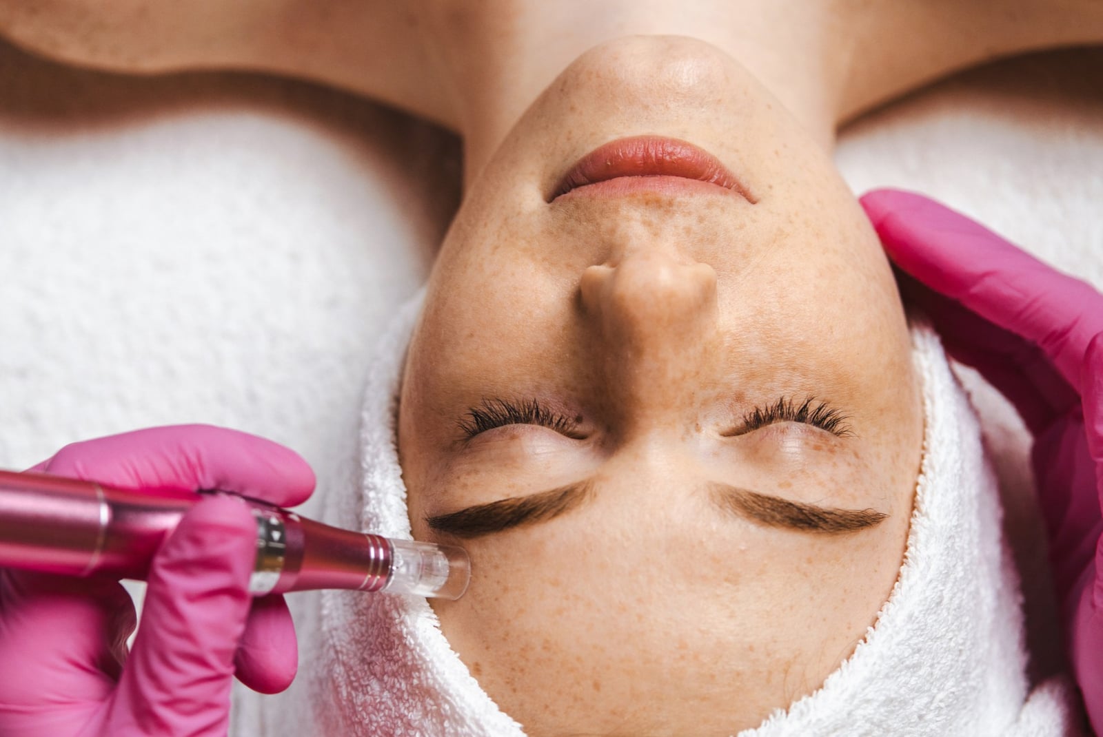 Is Microneedling Worth It?
