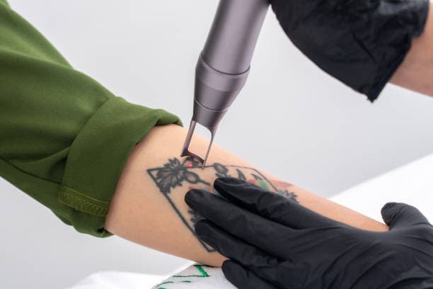 Can tattoos be removed?