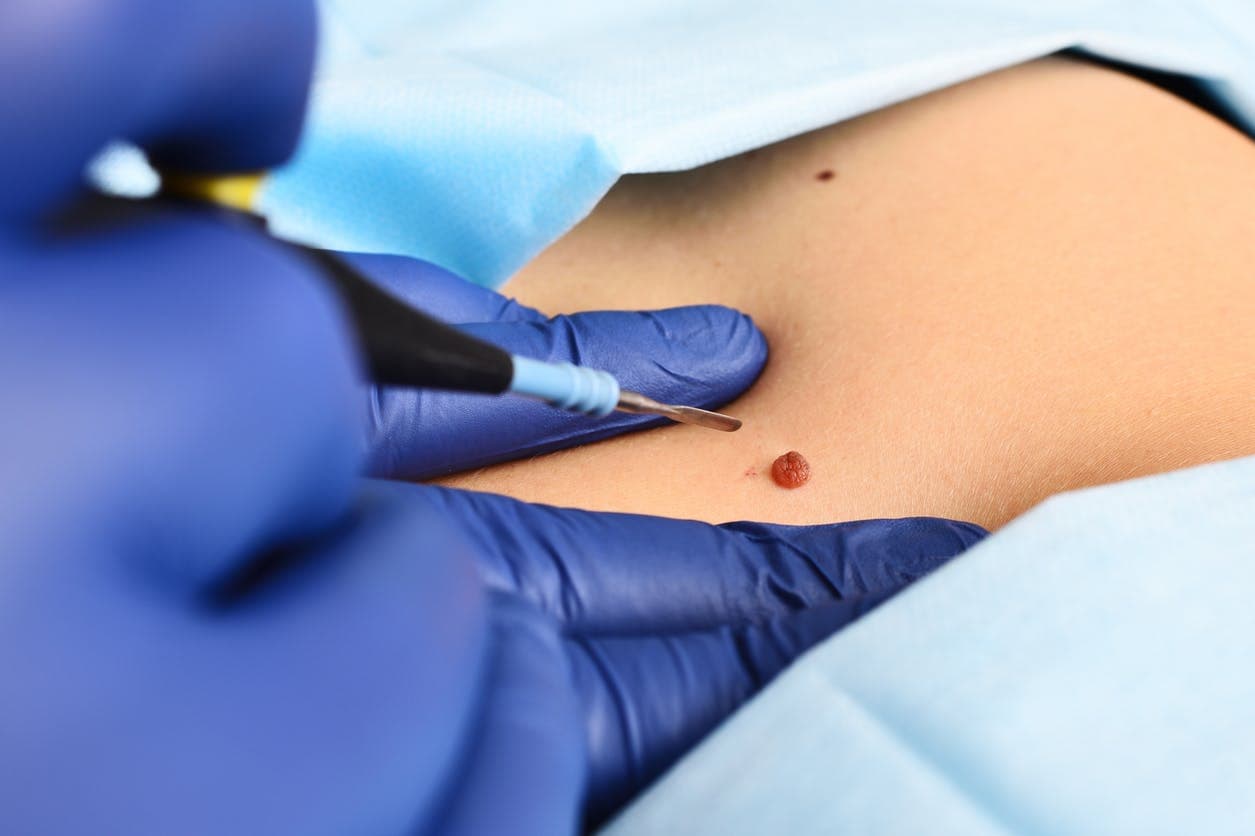 Why is mole removal done?