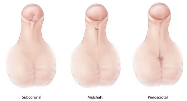 What is hypospadias?