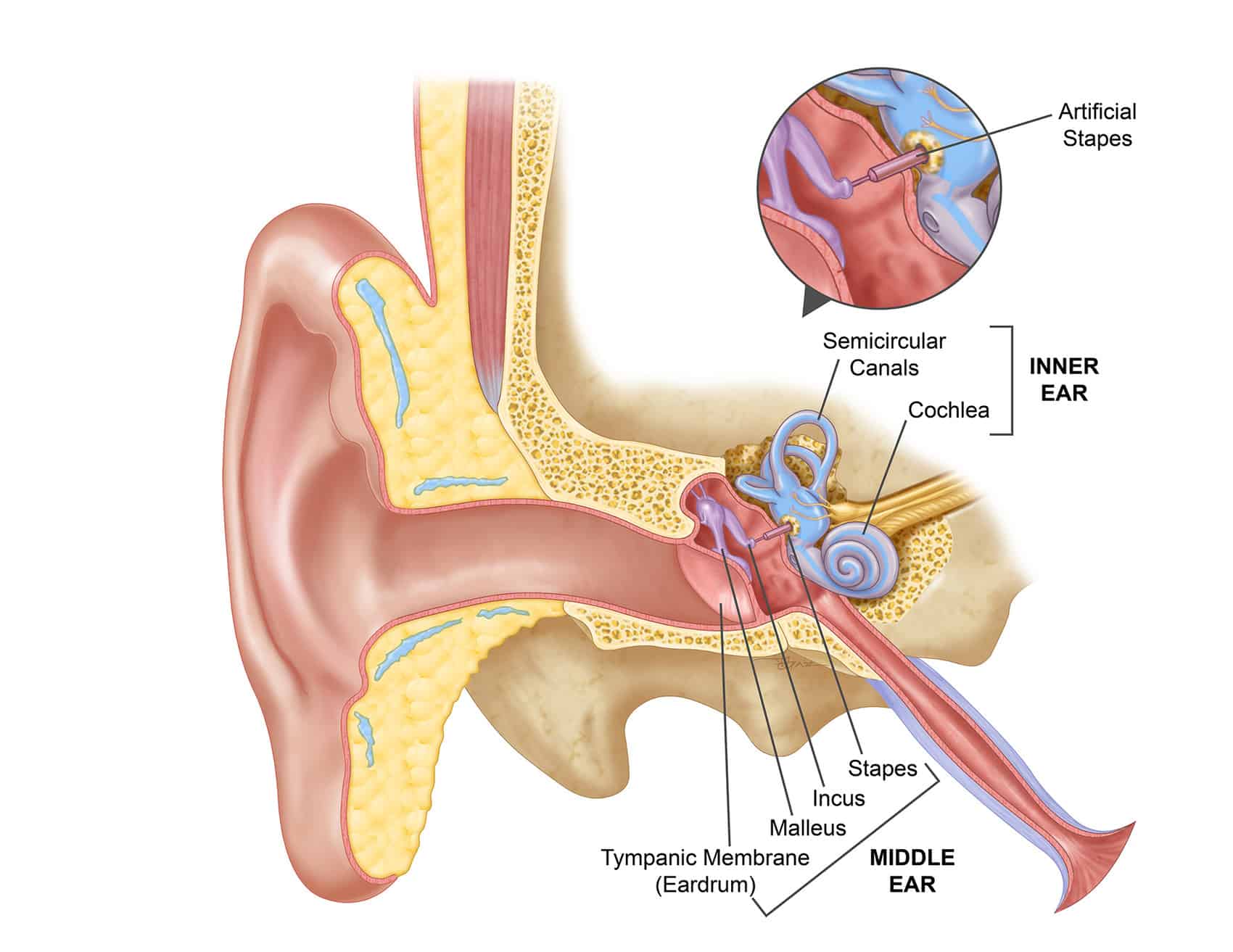 What is stapedectomy surgery?