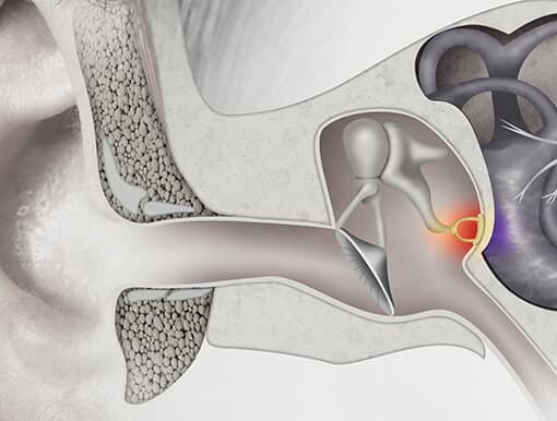 Stapedectomy recovery & long-term care