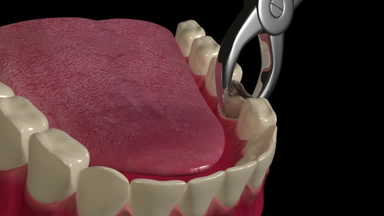 Anesthesia Options for Tooth Extraction