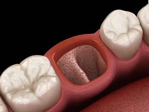 Simple vs. Surgical Tooth Extraction