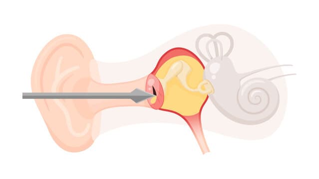 Benefits & risks of Myringotomy