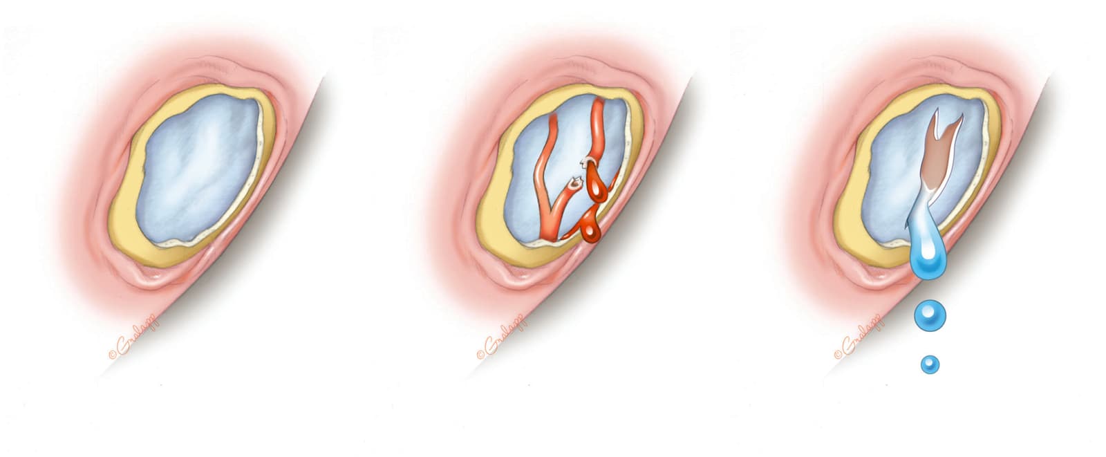 What Are the Indications for a Mastoidectomy?