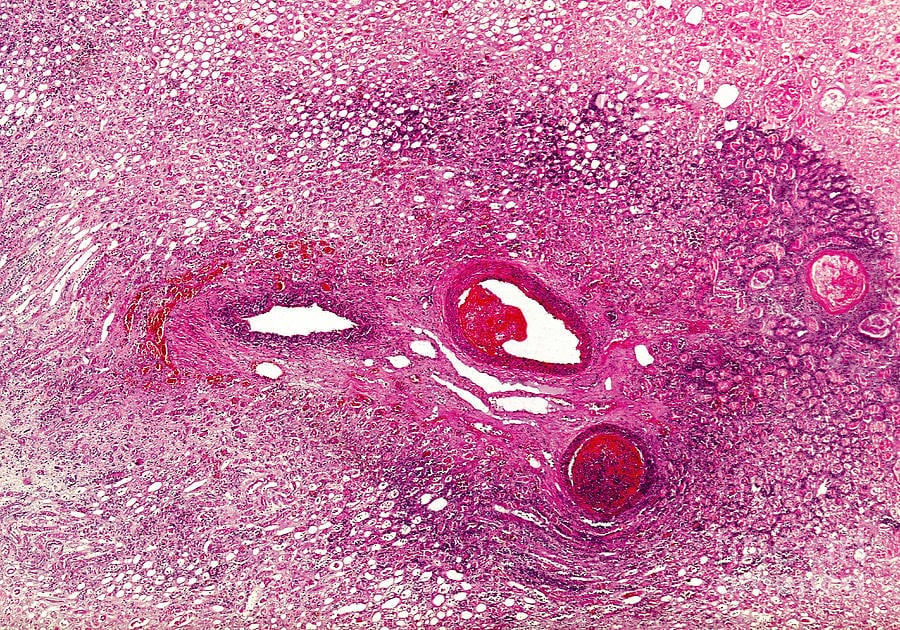 Different types of Coagulative Necrosis