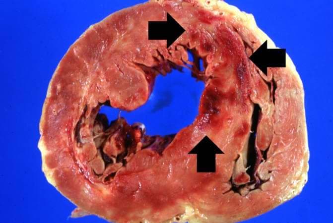What are the different types of coagulative necrosis?