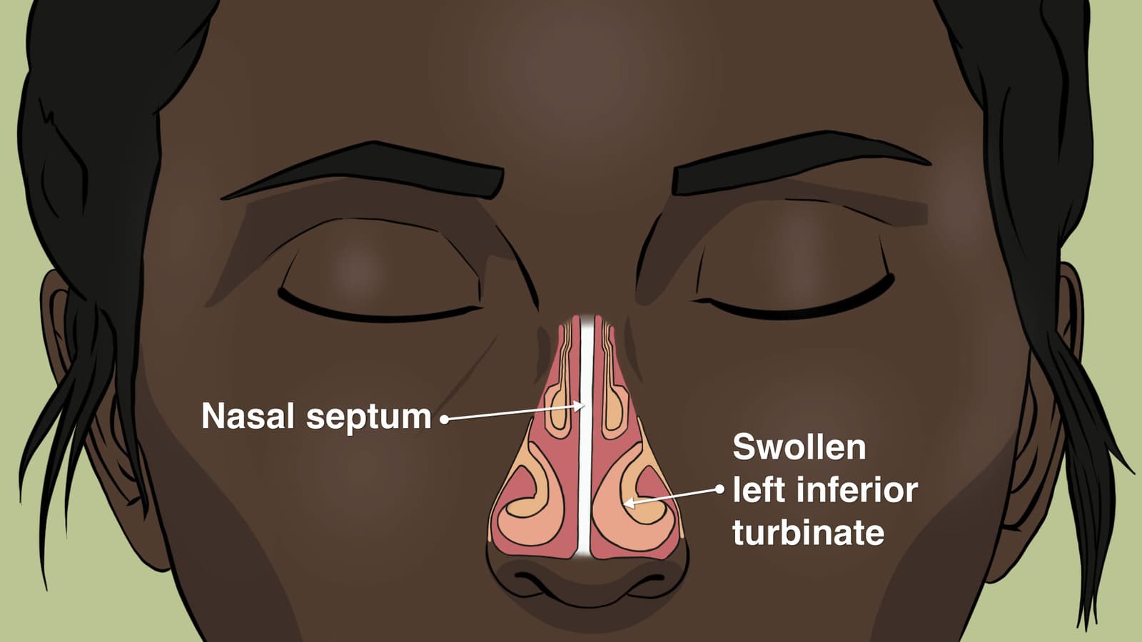 What are the pros and cons of turbinate reduction surgery?