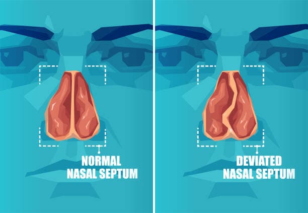 What happens during septoplasty?