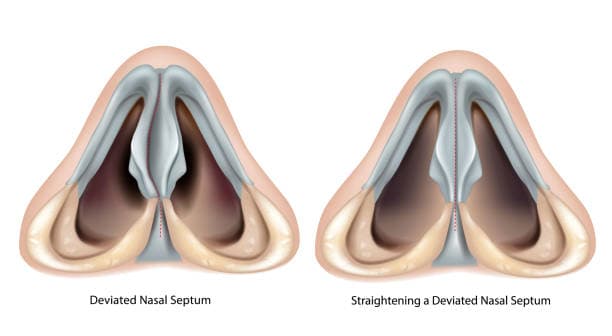 What are the alternatives to a septoplasty?