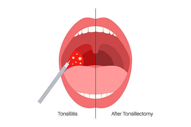 What can I eat after a tonsillectomy?