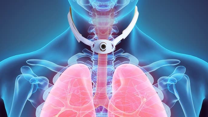 What is a laryngectomy?