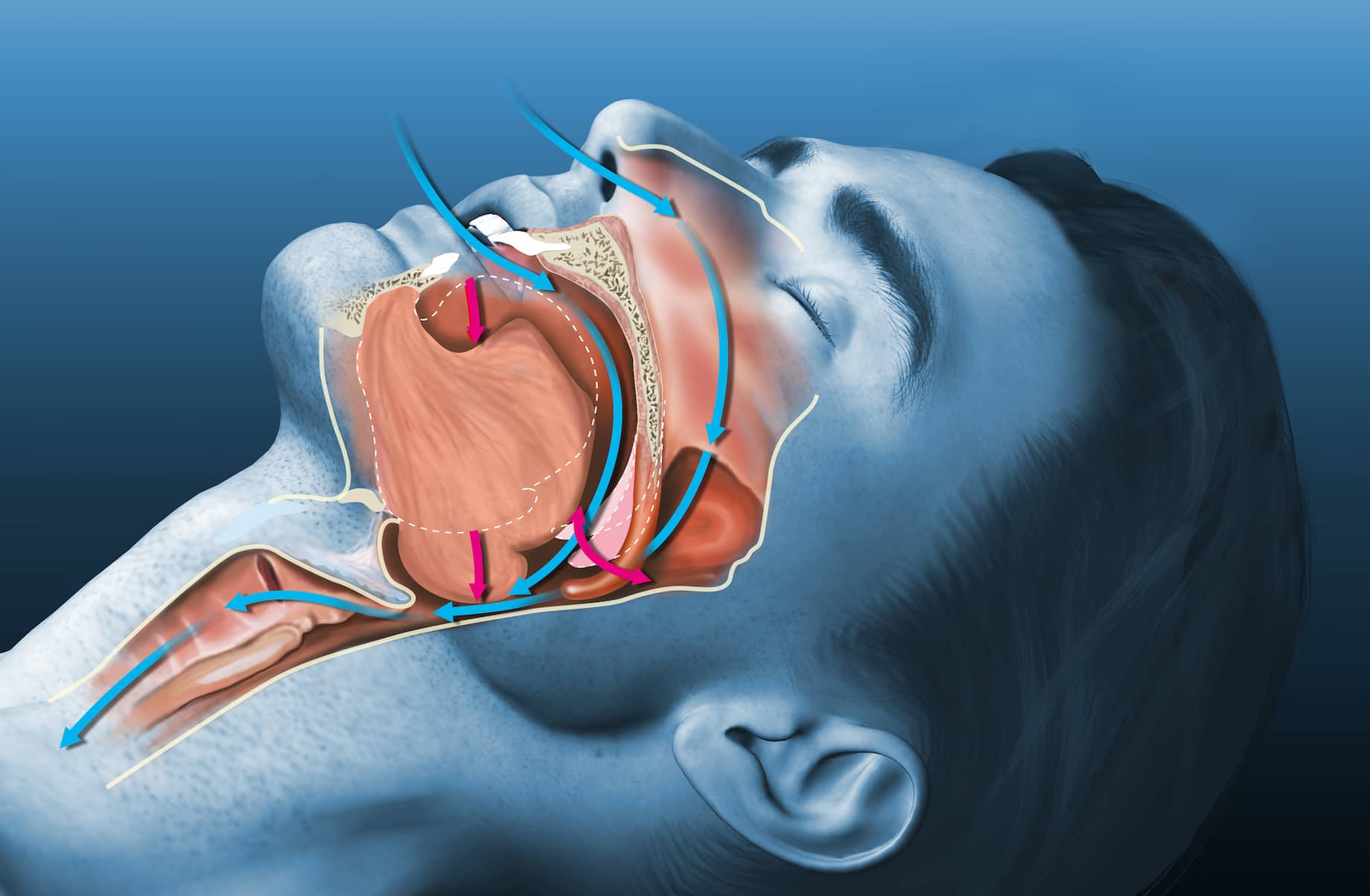 What Is UPPP Surgery?