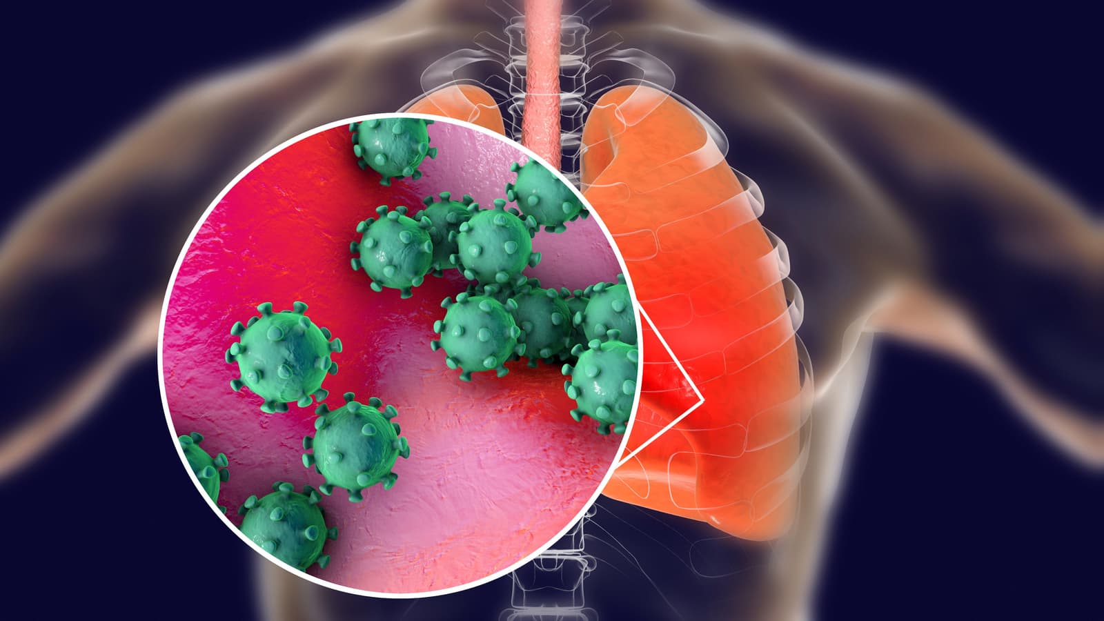 What causes chronic bronchitis?