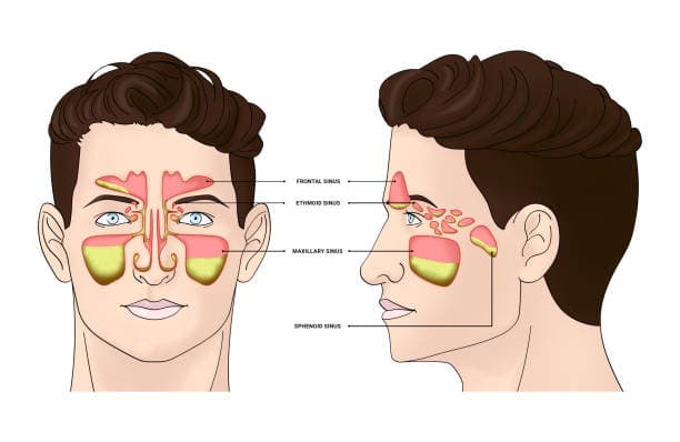How is sinus infection treated?