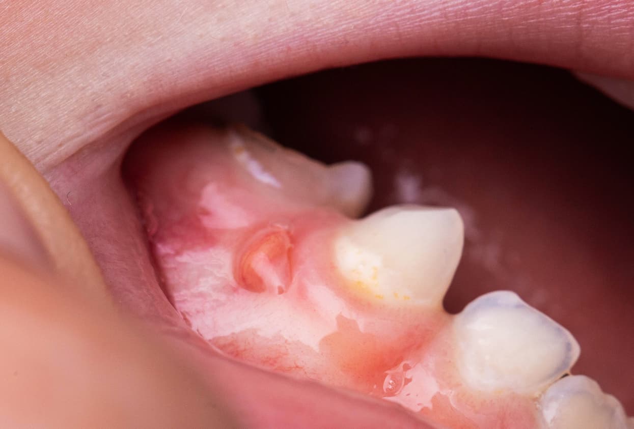 Treatments for Gum Disease