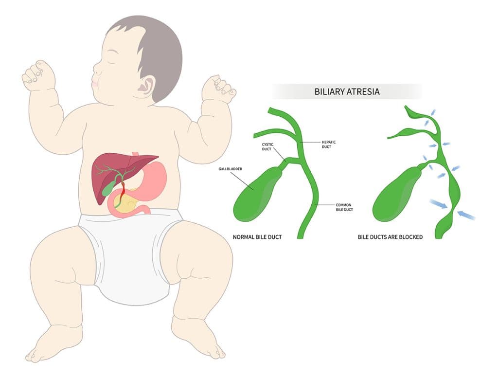How is biliary atresia diagnosed?