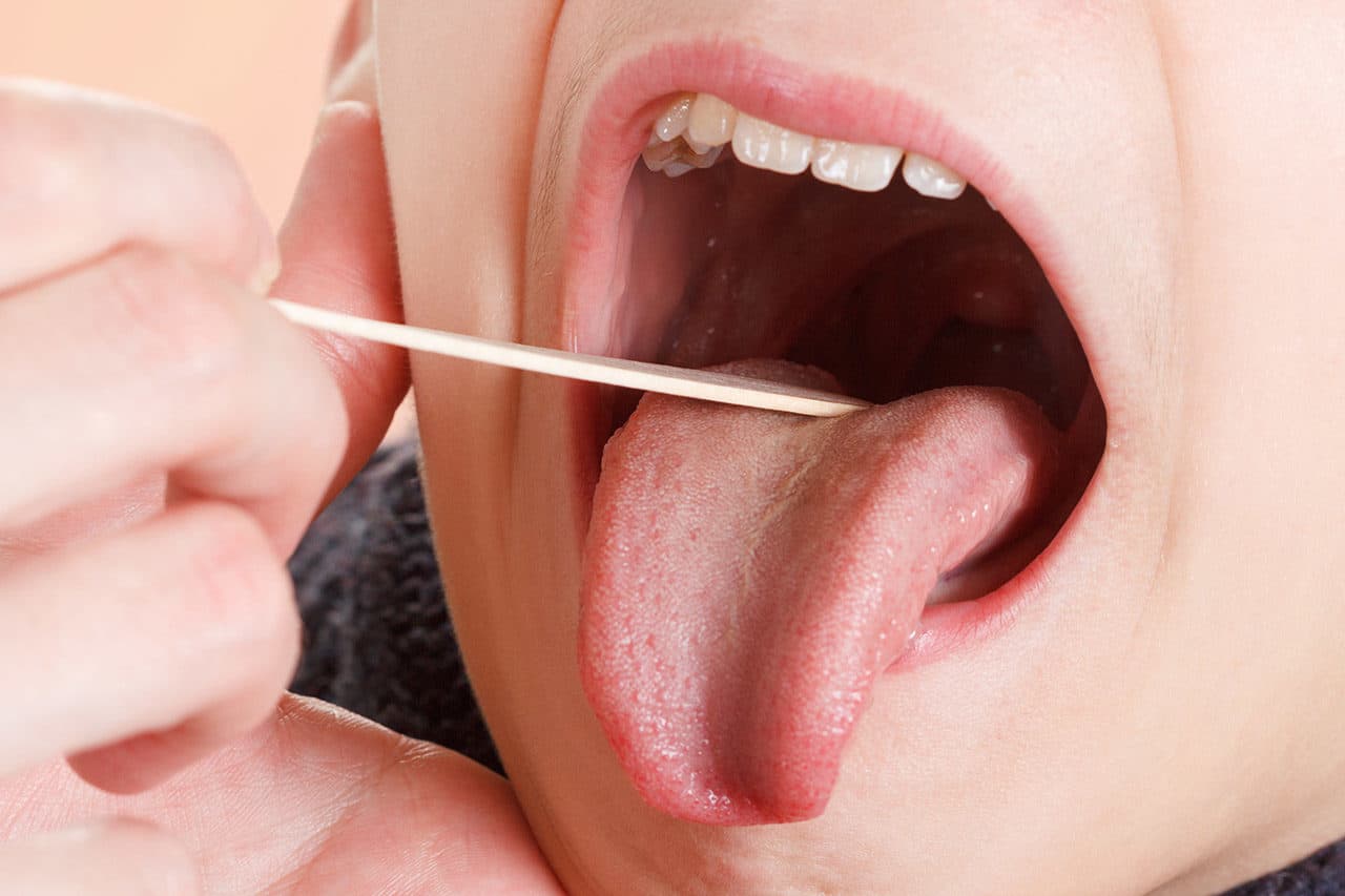 What is adenoidectomy procedure?
