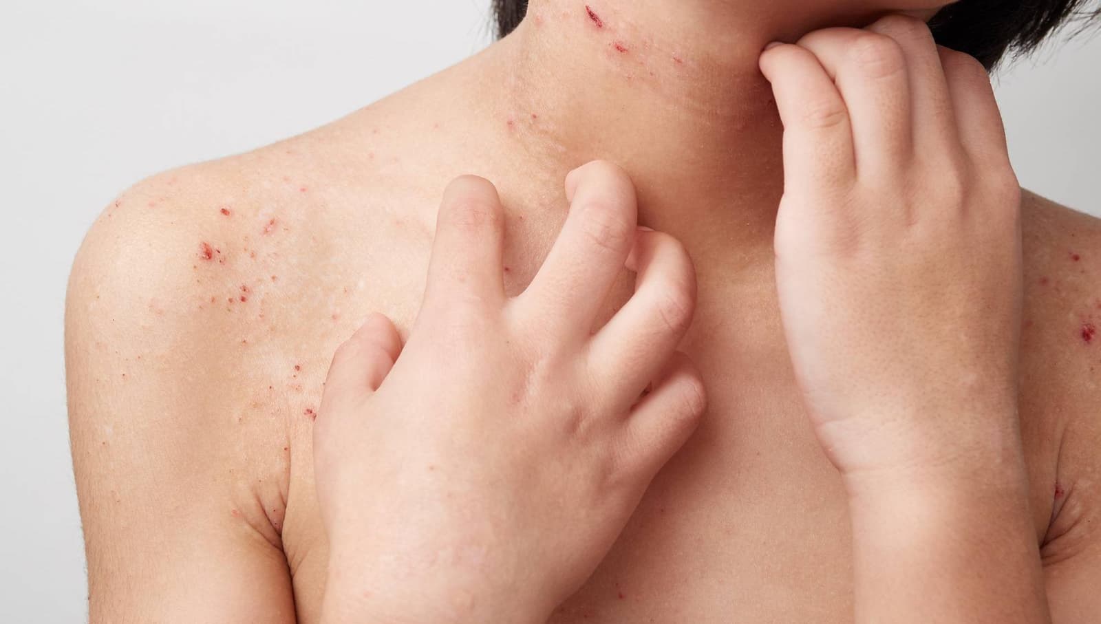 What is eczema?