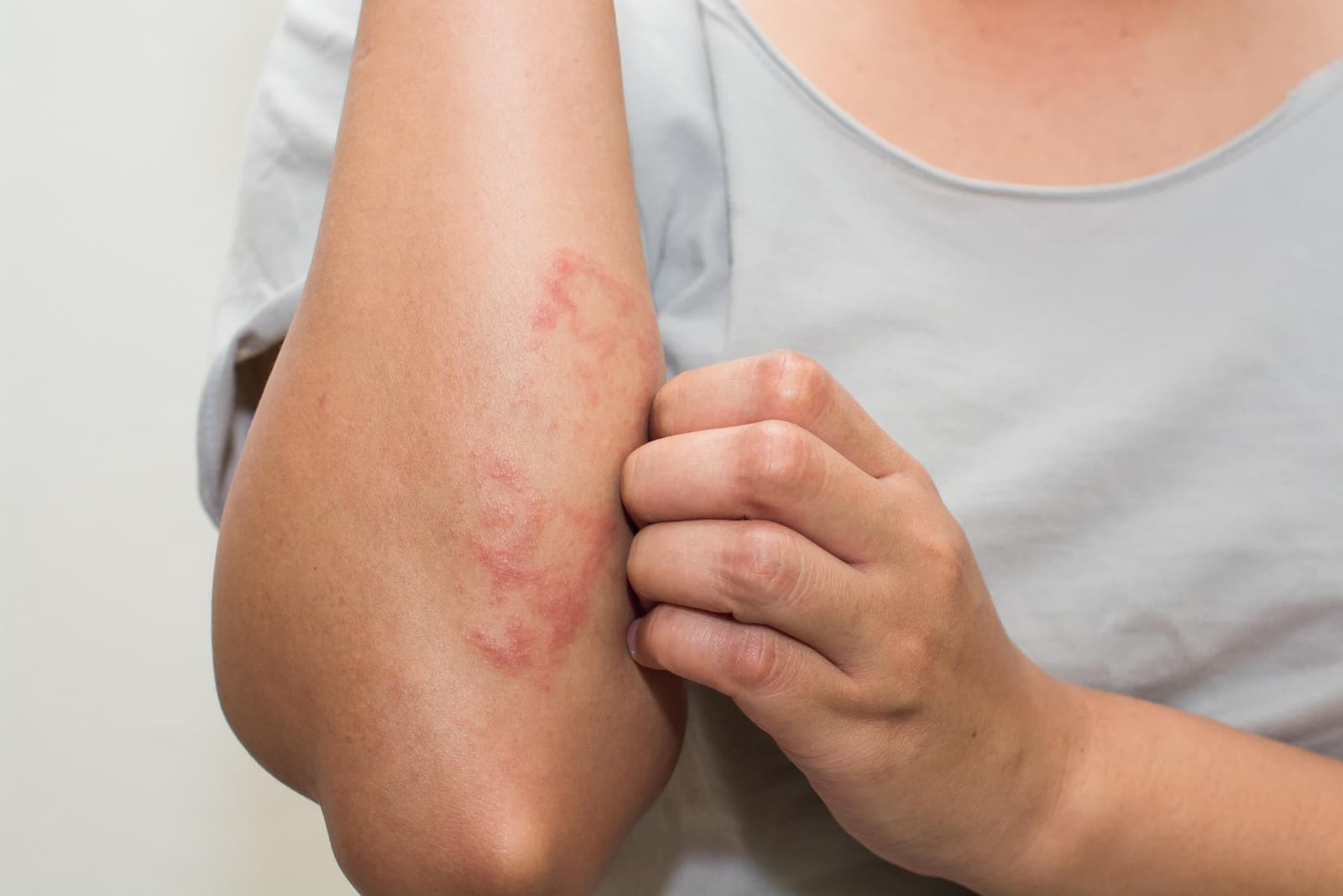 Who does eczema affect?
