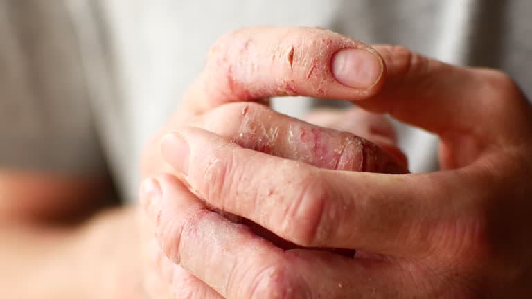 What triggers eczema to flare-up?