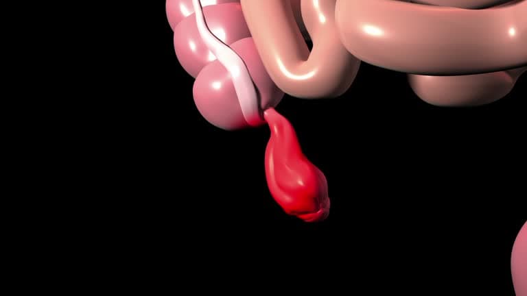 What other conditions might be confused with appendicitis?
