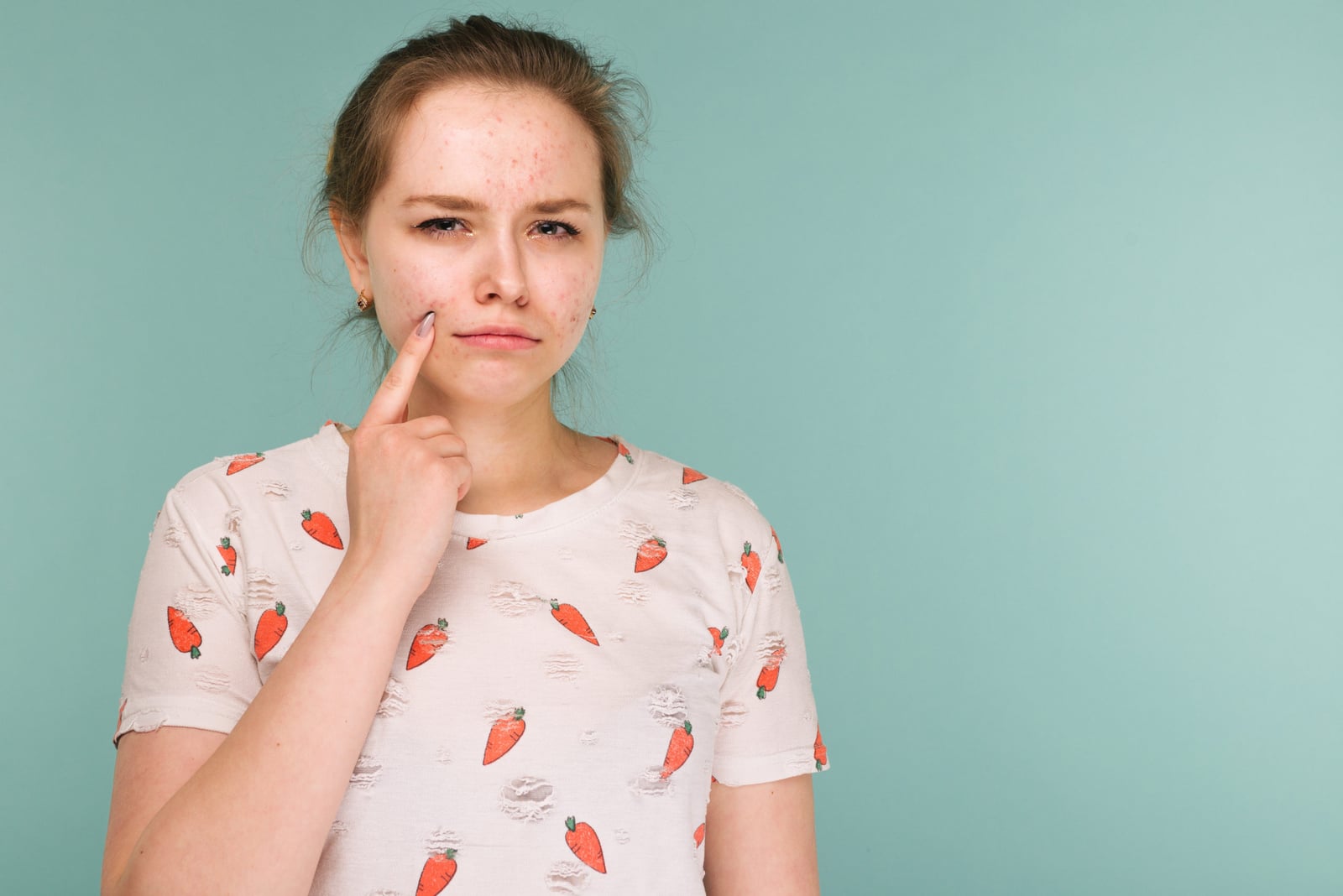 Different Types of Acne & How to Treat Them