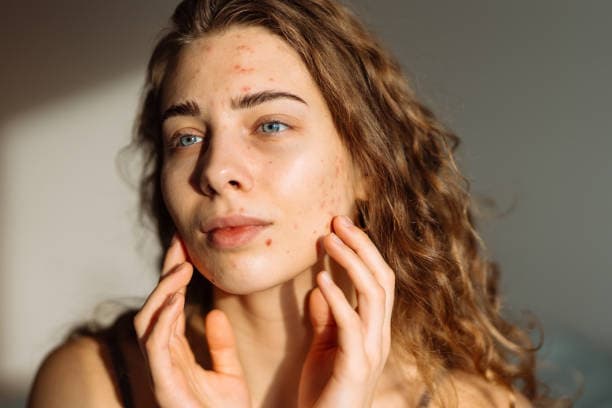 What are treatment options for acne?