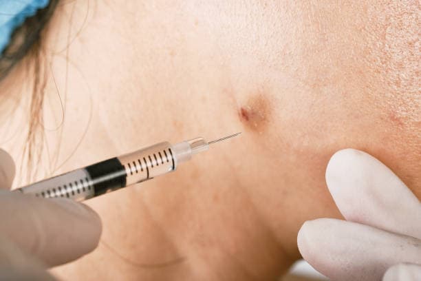 How can acne be prevented & managed?