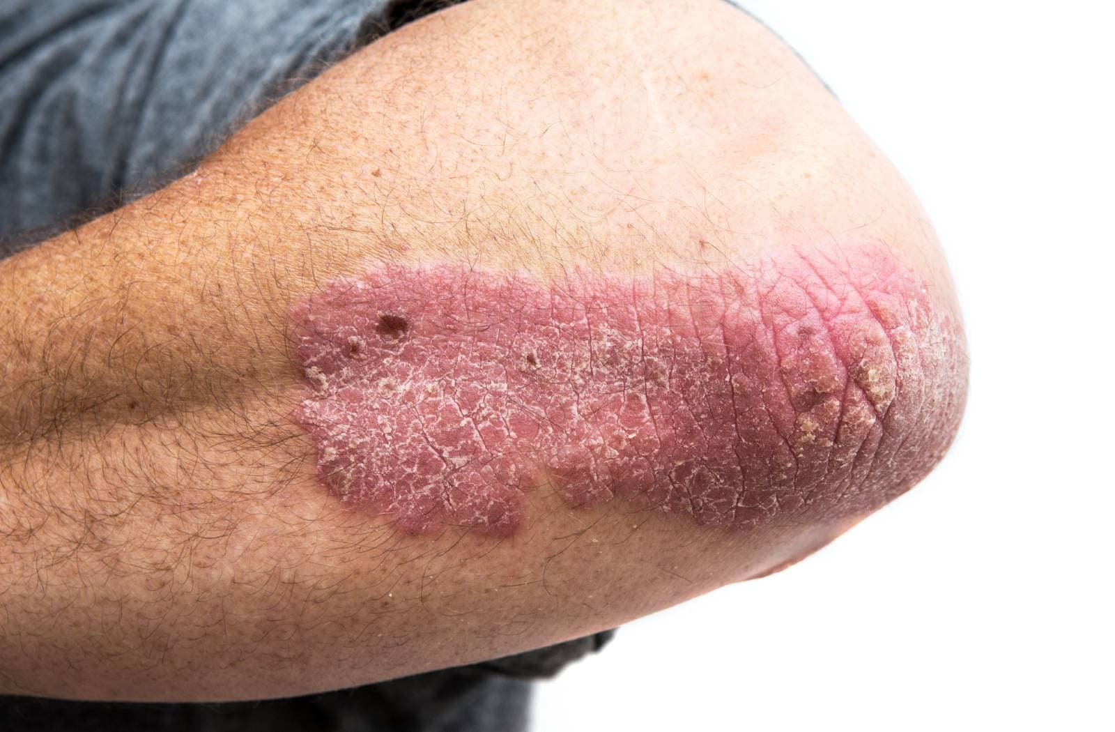 How is psoriasis managed?