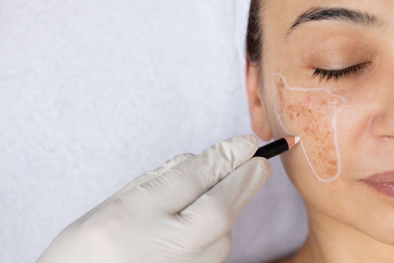 Is there a cure for melasma?