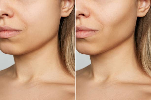 What is the recovery time for buccal fat removal surgery?