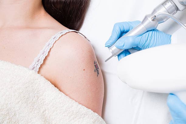 Who is a candidate for tattoo removal?