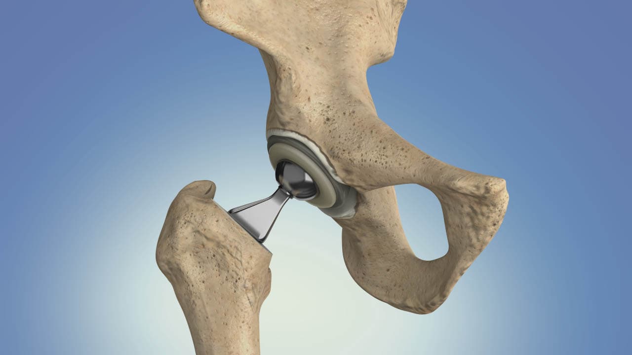 Why Do People Need Hip Replacement?