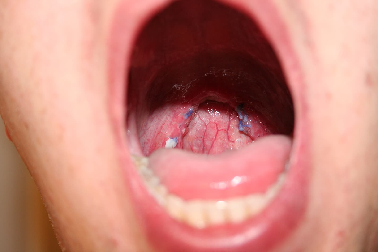 What causes snoring?