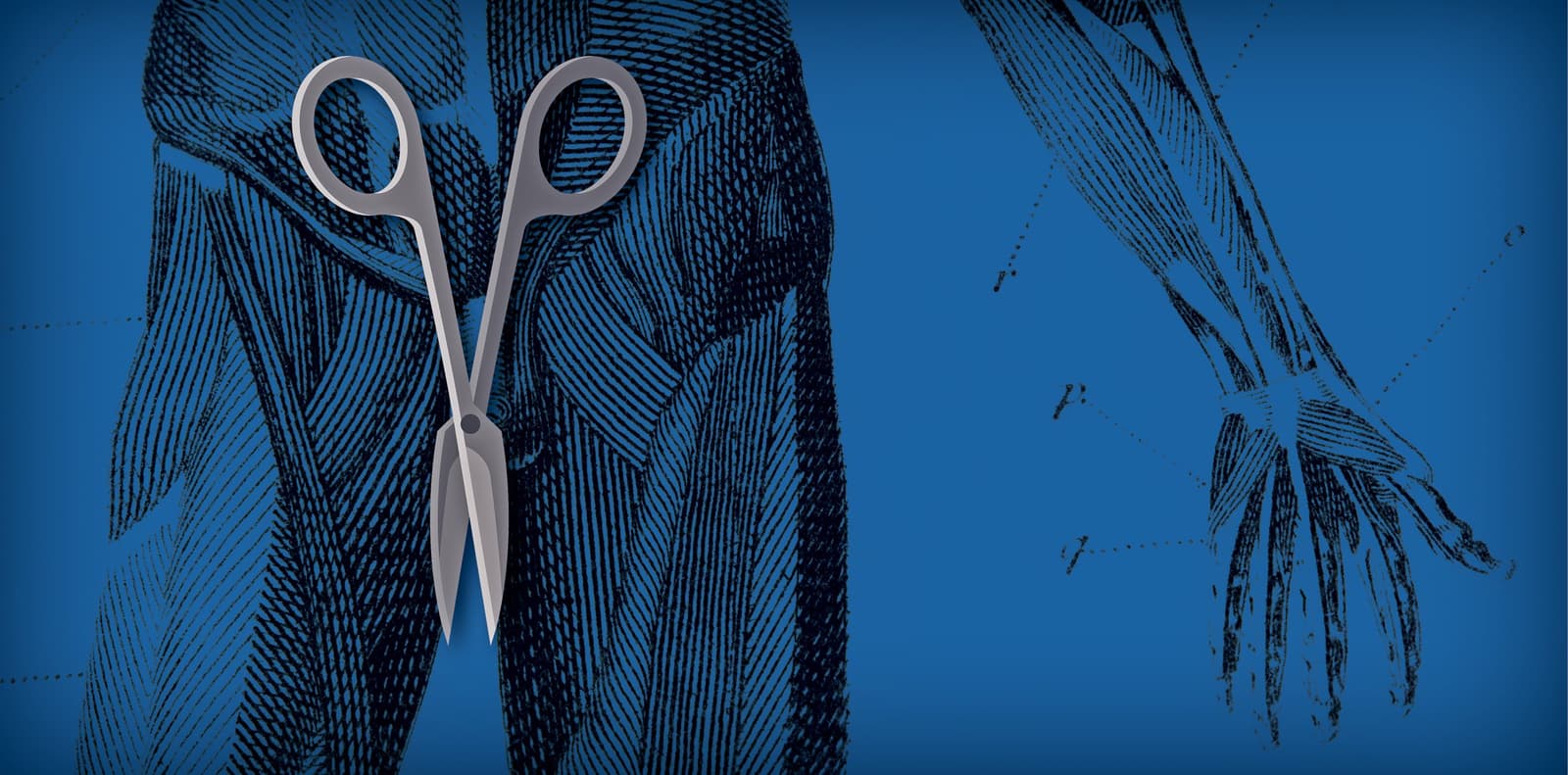 What is a vasectomy?