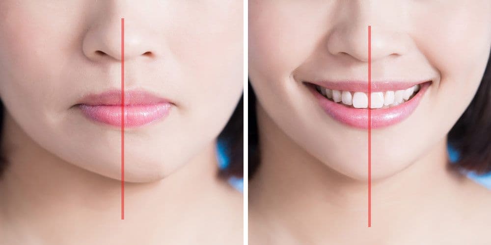 What happens during a jaw surgery?