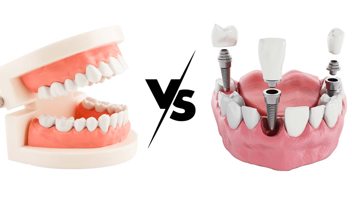 Dentures vs. Dental Implants