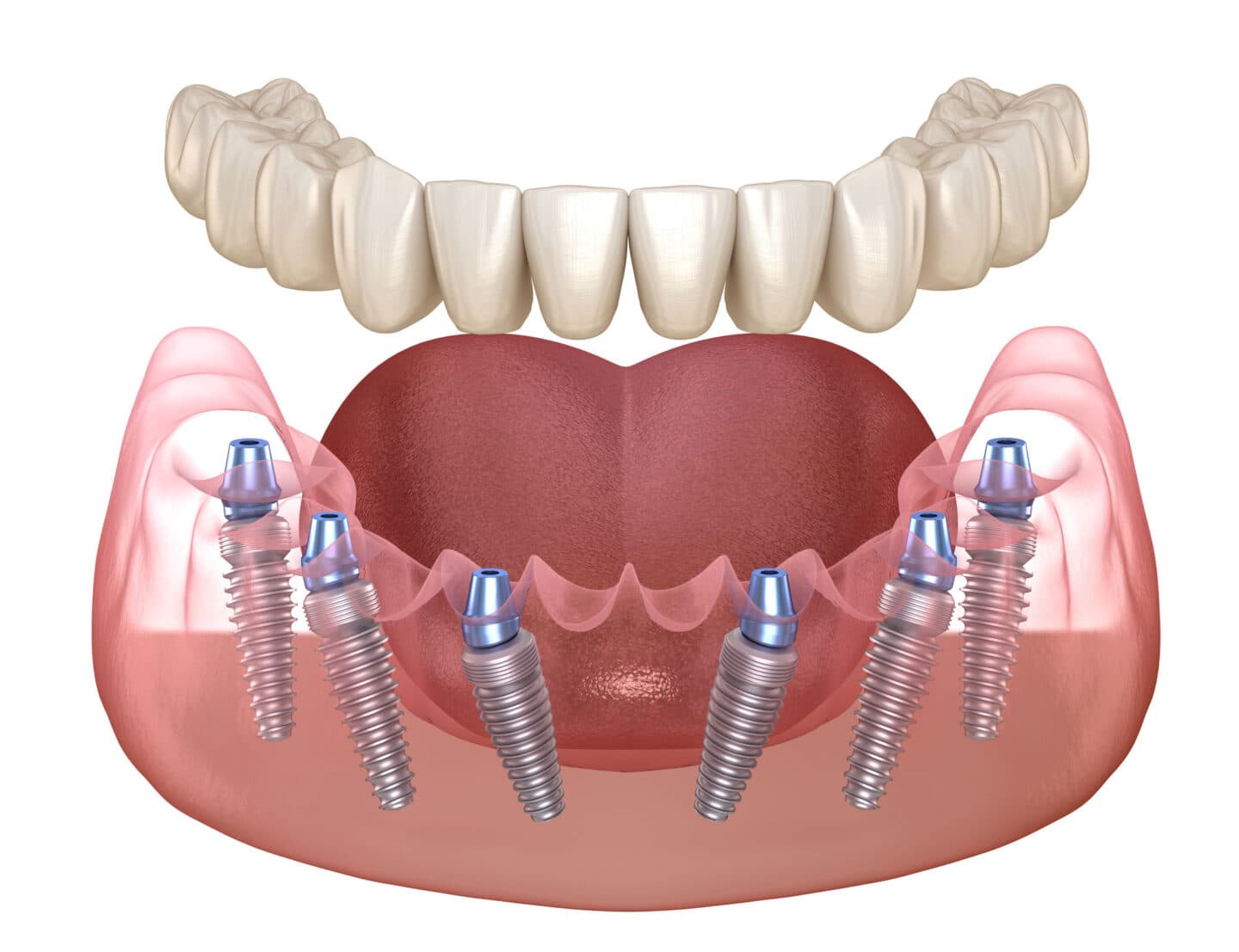 What are the advantages of dental implants?