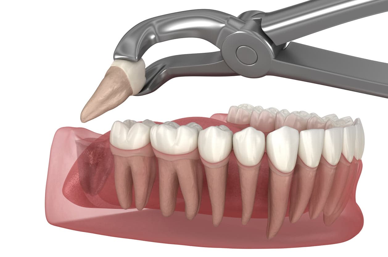 What is a tooth extraction?