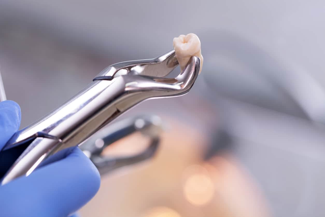 Tooth extraction aftercare