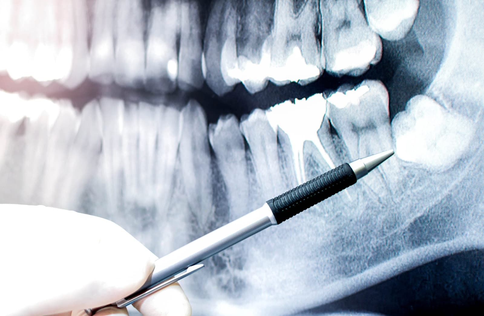 What to eat after a tooth extraction?