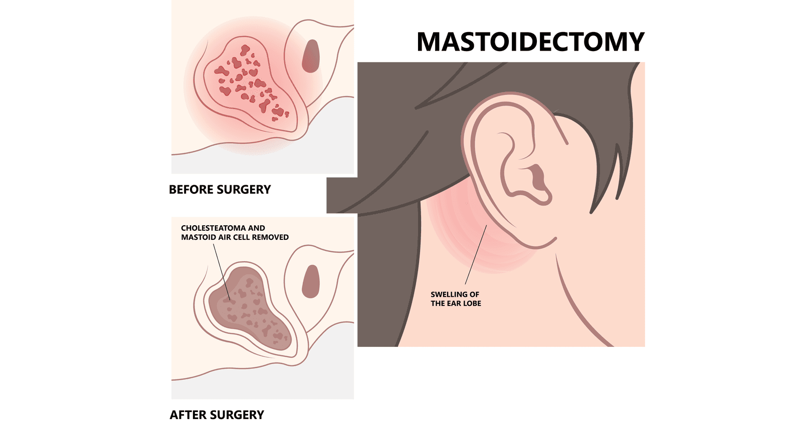 Why is Mastoidectomy performed?